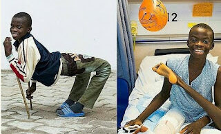 12-years-old boy with backward leg can now stand and walk straight after a successful surgery (PHOTOS)